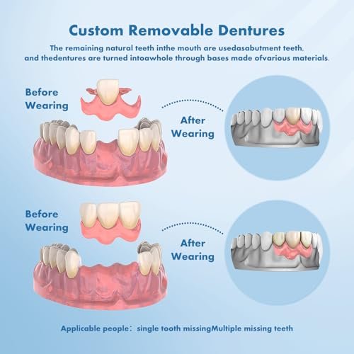 Qiivosm - Custom Removable Dentures Set for Tooth Replacement (4 Teeth)